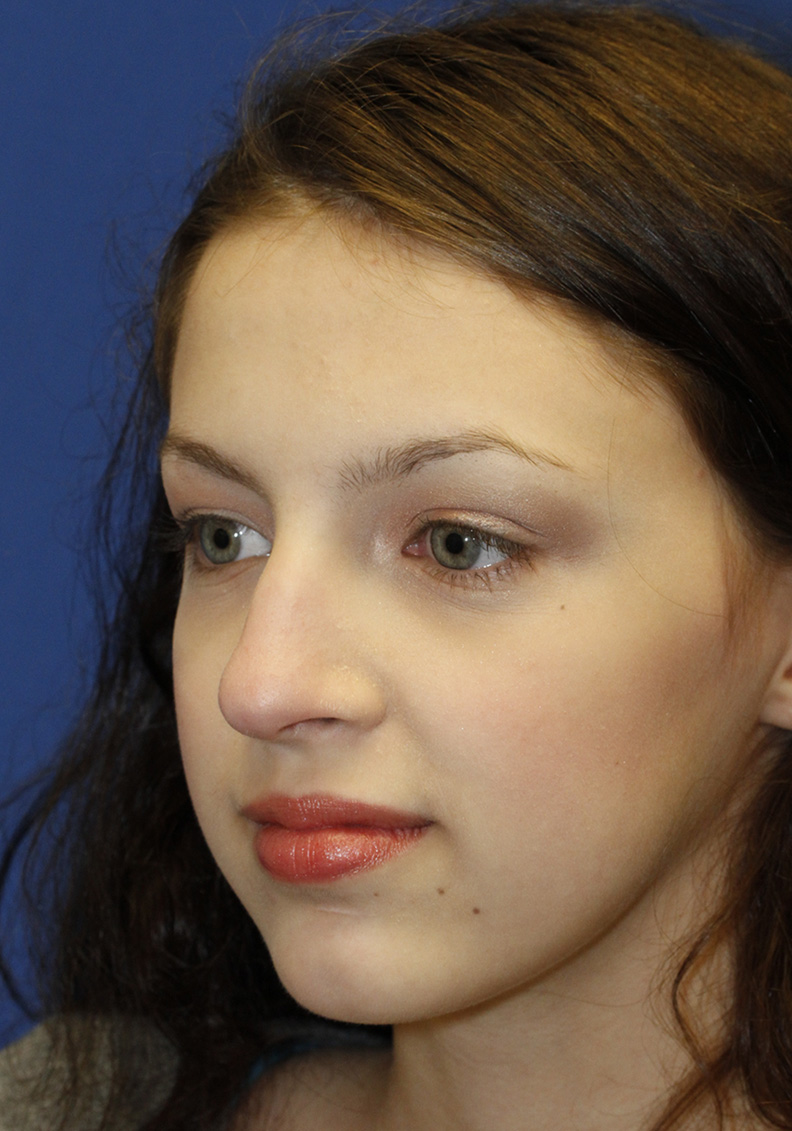 Rhinoplasty Before L Oblique