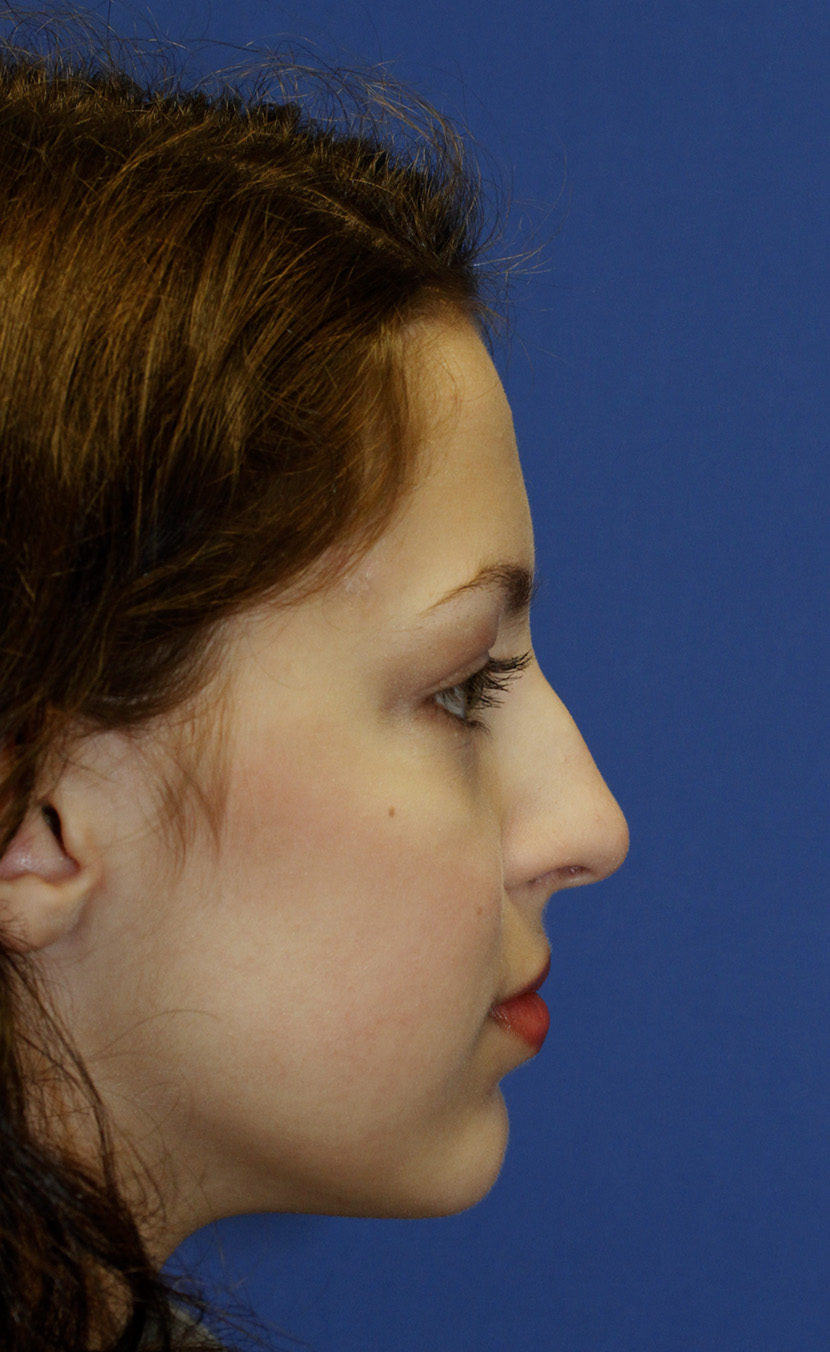 Rhinoplasty Before R Profile