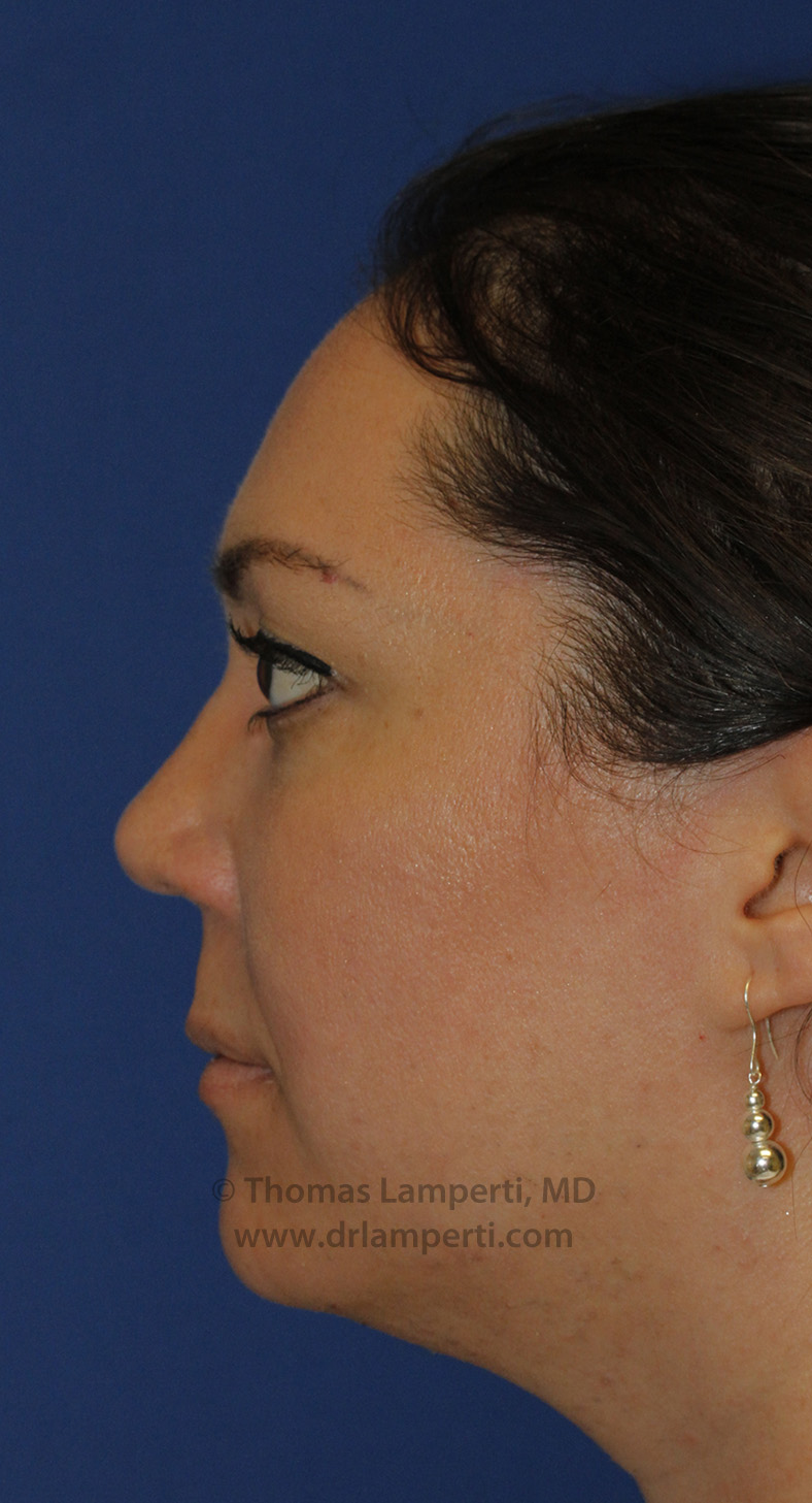 Rhinoplasty After L Profile