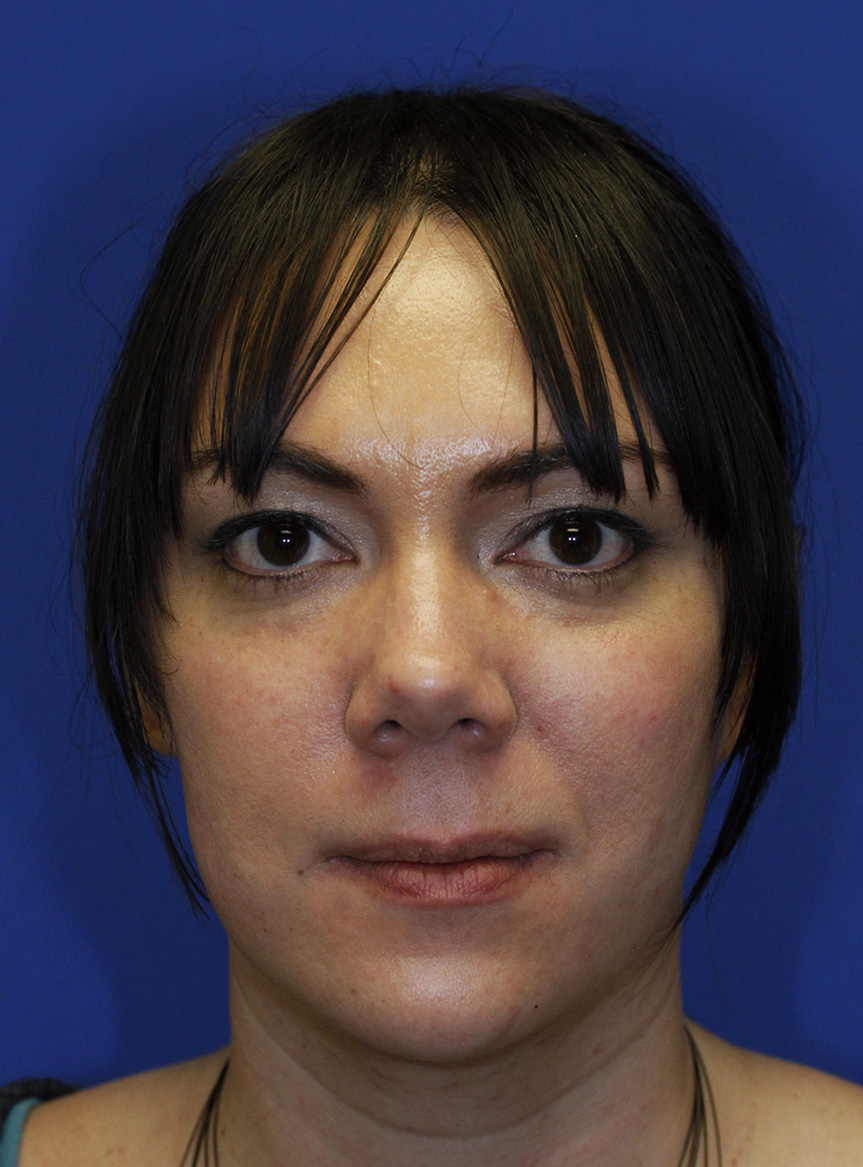 Rhinoplasty Before Frontal