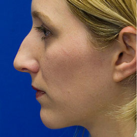 Before Bridge Hump Rhinoplasty