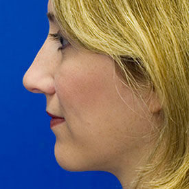 After Bridge Hump Rhinoplasty