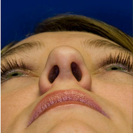 After Rhinoplasty Photo