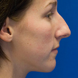 Before dorsal hump rhinoplasty