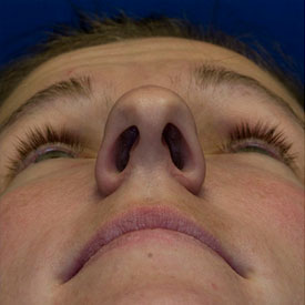 Before Bulbous Nose Rhinoplasty