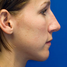 After bulbous nose rhinoplasty