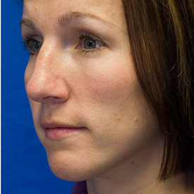 After Rhinoplasty Oblique Photo