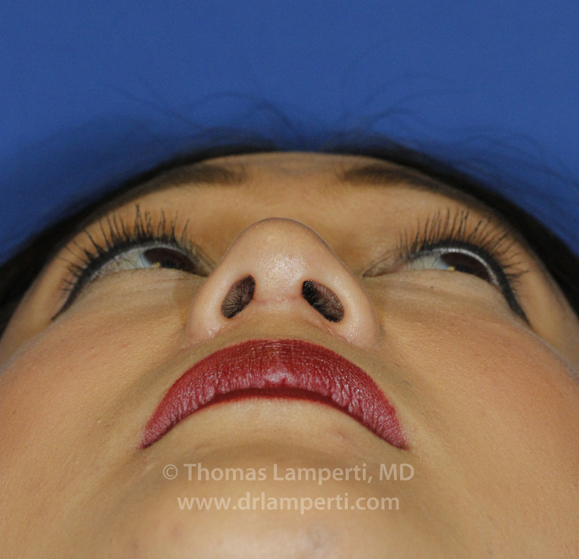 Rhinoplasty Base After