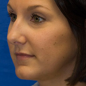 Before Oblique Rhinoplasty Photo