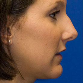 Before Profile Rhinoplasty Photo