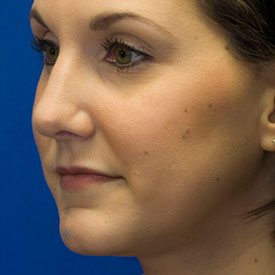 After Oblique Rhinoplasty Photo