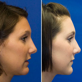 After Profile Rhinoplasty Photo