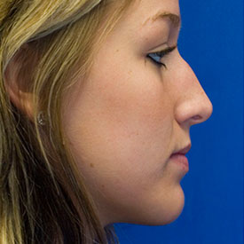 Before Profile Rhinoplasty Photo