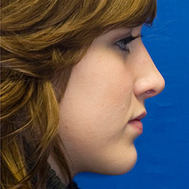 After Profile Rhinoplasty Photo