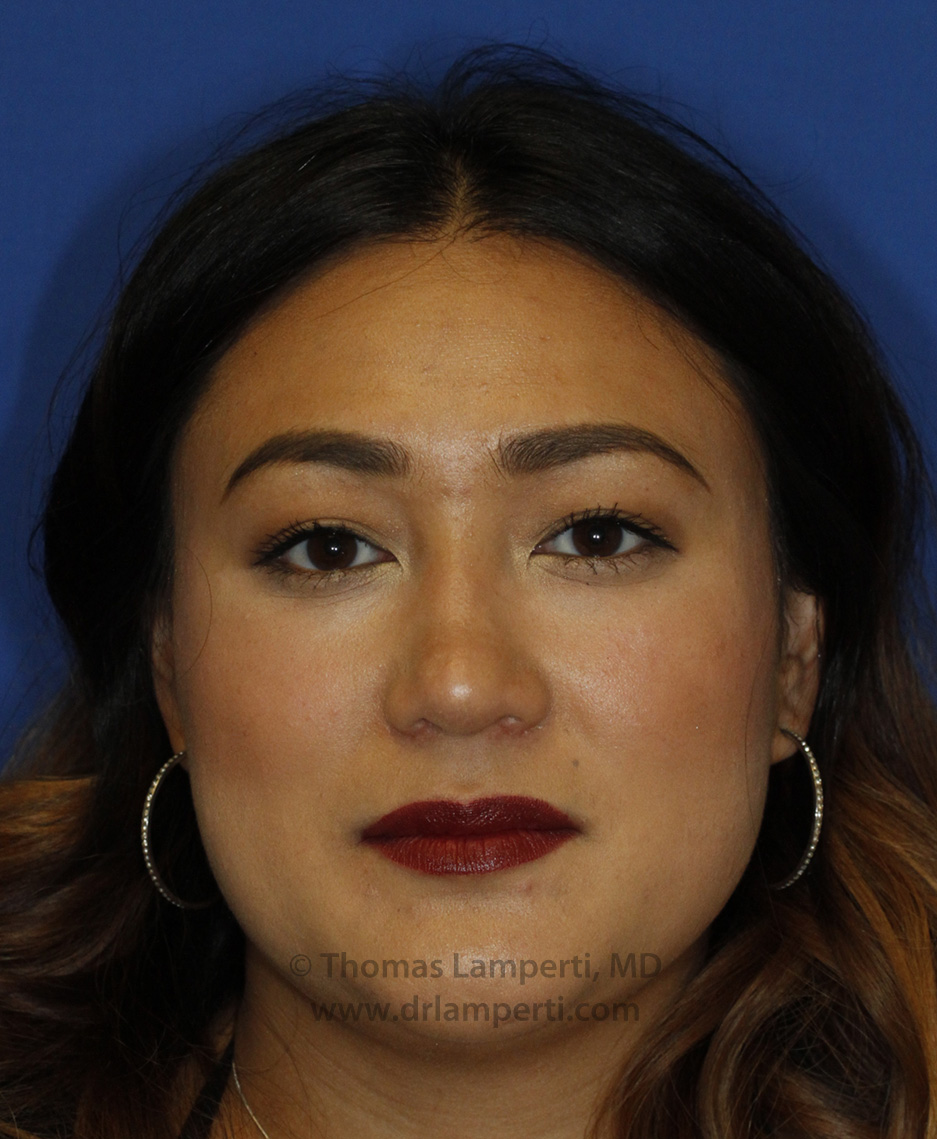 Rhinoplasty Frontal After
