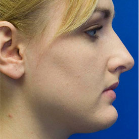 Before Rhinoplasty Profile Photo