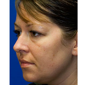 Before Rhinoplasty Oblique Photo