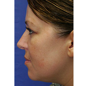 After Rhinoplasty Profile Photo