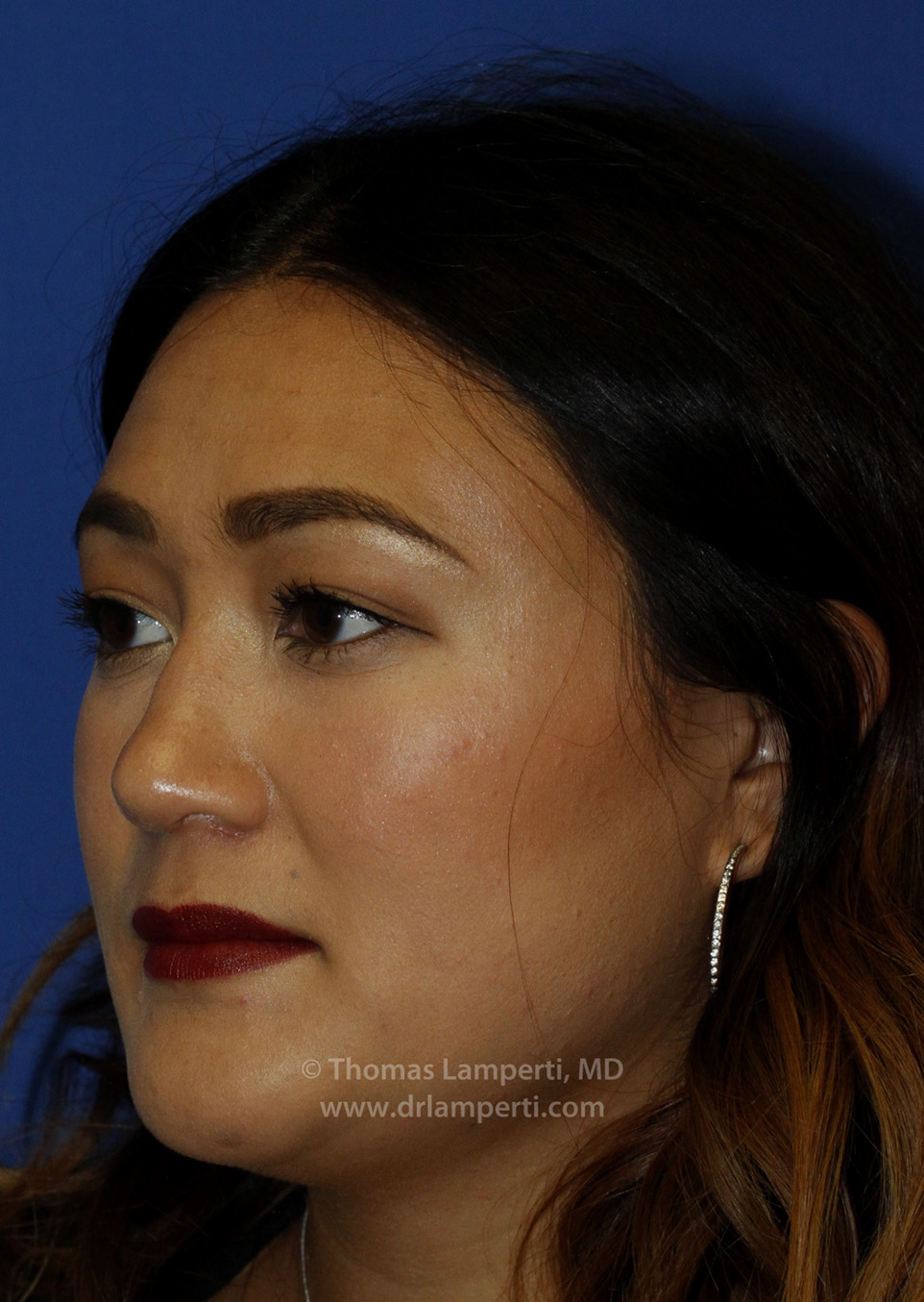 Rhinoplasty L Oblique After