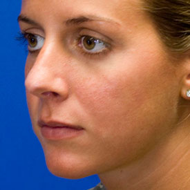 Before Rhinoplasty Oblique Photo