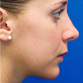 After Rhinoplasty Profile Photo