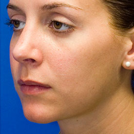 After Rhinoplasty Oblique Photo