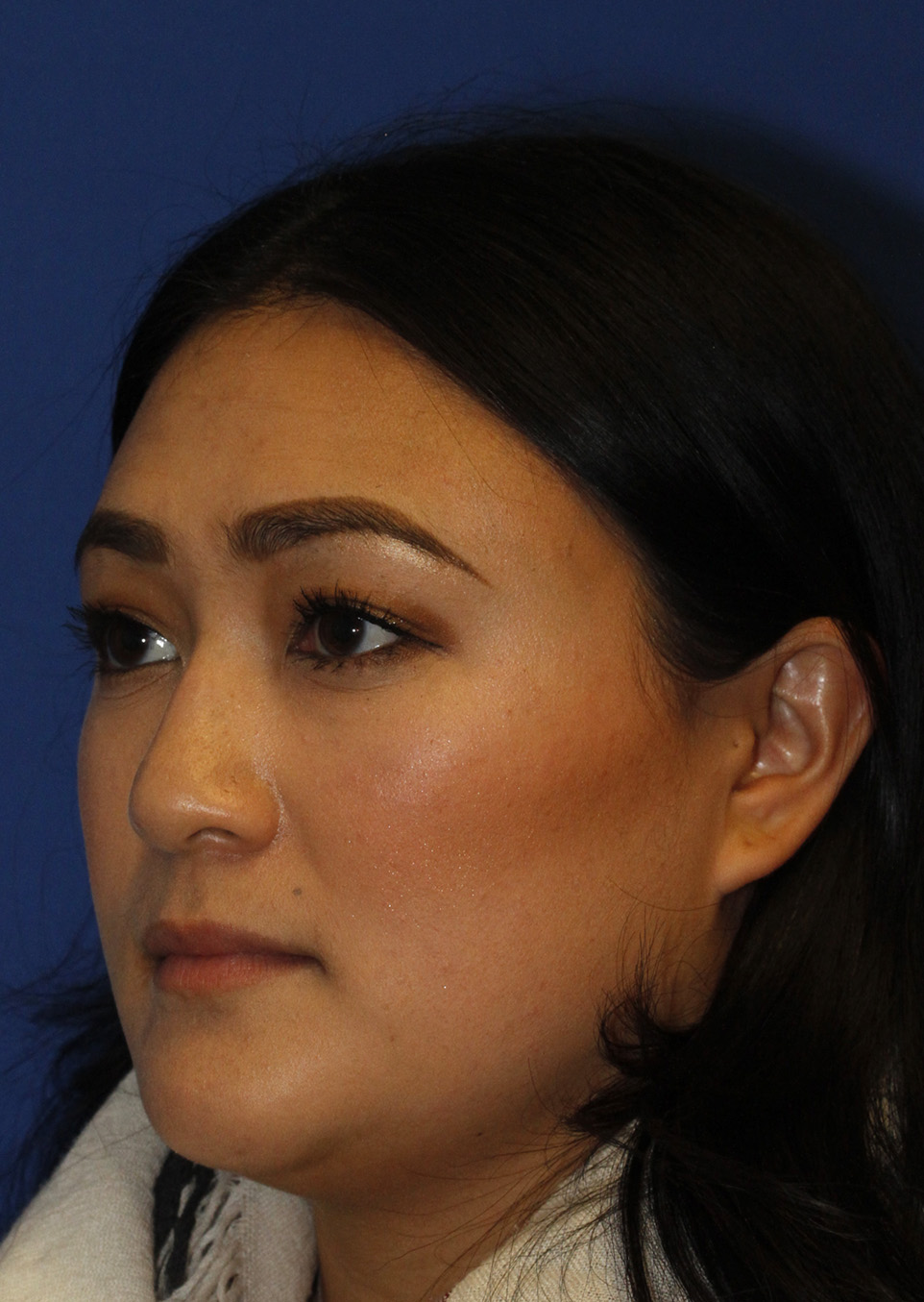 Rhinoplasty L Oblique Before