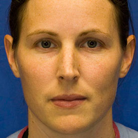 Before Rhinoplasty Frontal Photo