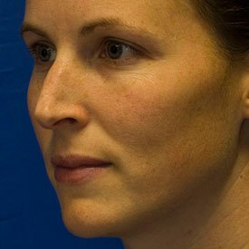 Before Rhinoplasty Oblique Photo