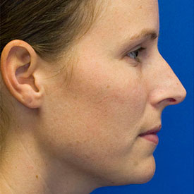 Before Rhinoplasty Profile Photo