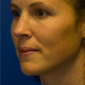 After Rhinoplasty Oblique Photo