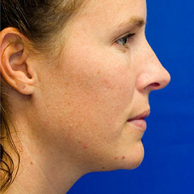 After Rhinoplasty Profile Photo