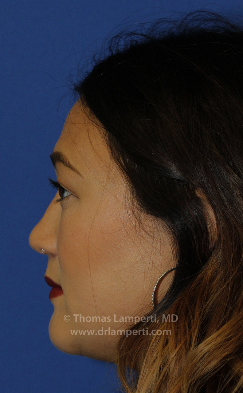 Rhinoplasty L Profile After