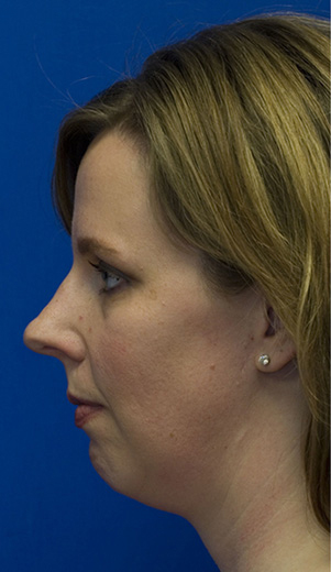 Before Rhinoplasty Photo