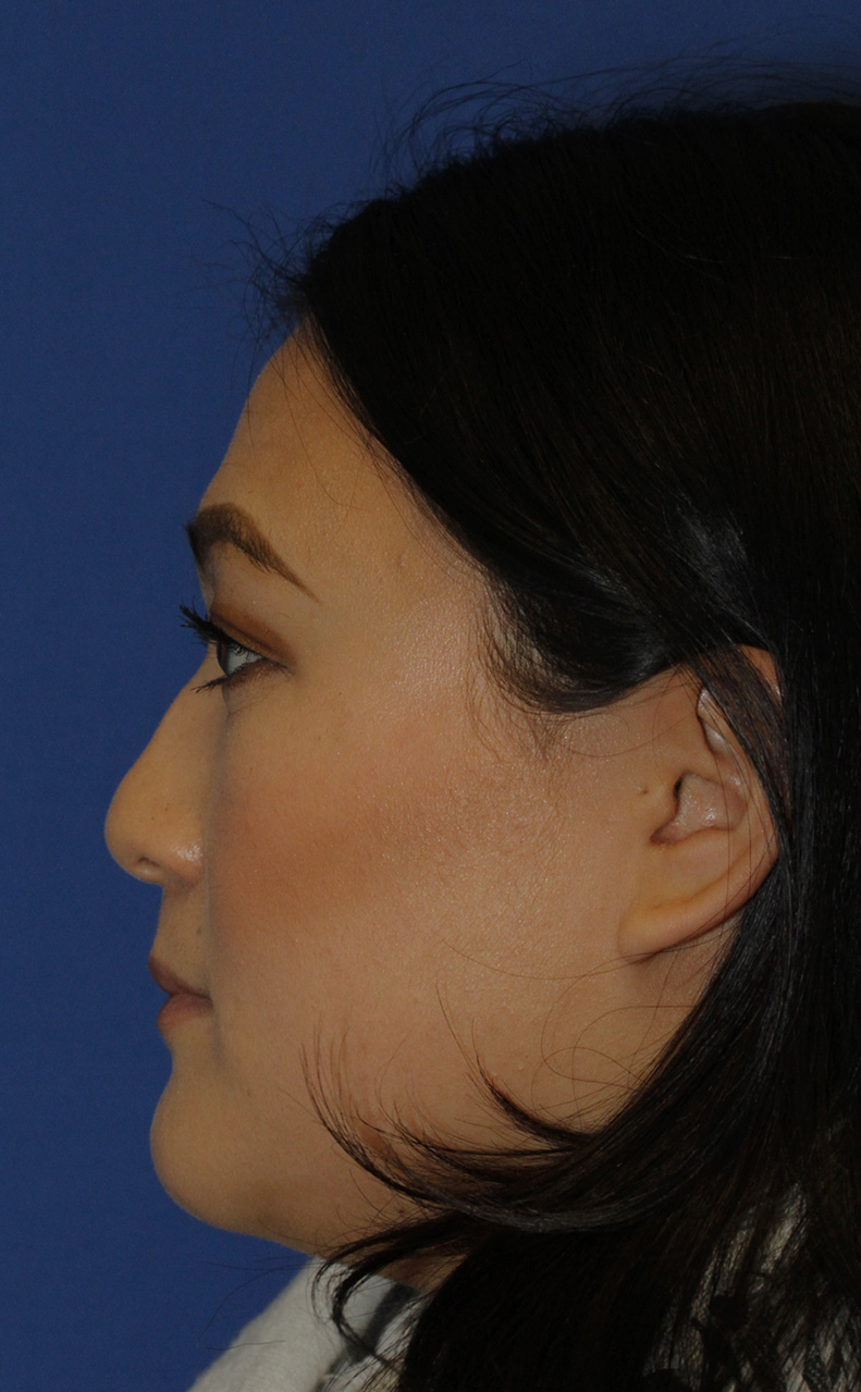 Rhinoplasty L Profile Before