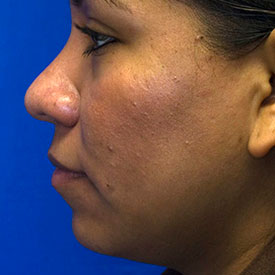 Before Ethnic Rhinoplasty Photo