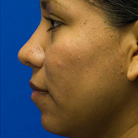 After Ethnic Rhinoplasty Photo