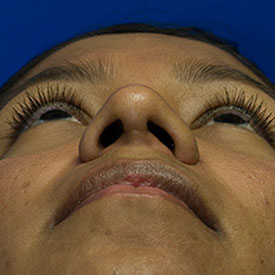 After Ethnic Rhinoplasty Photo