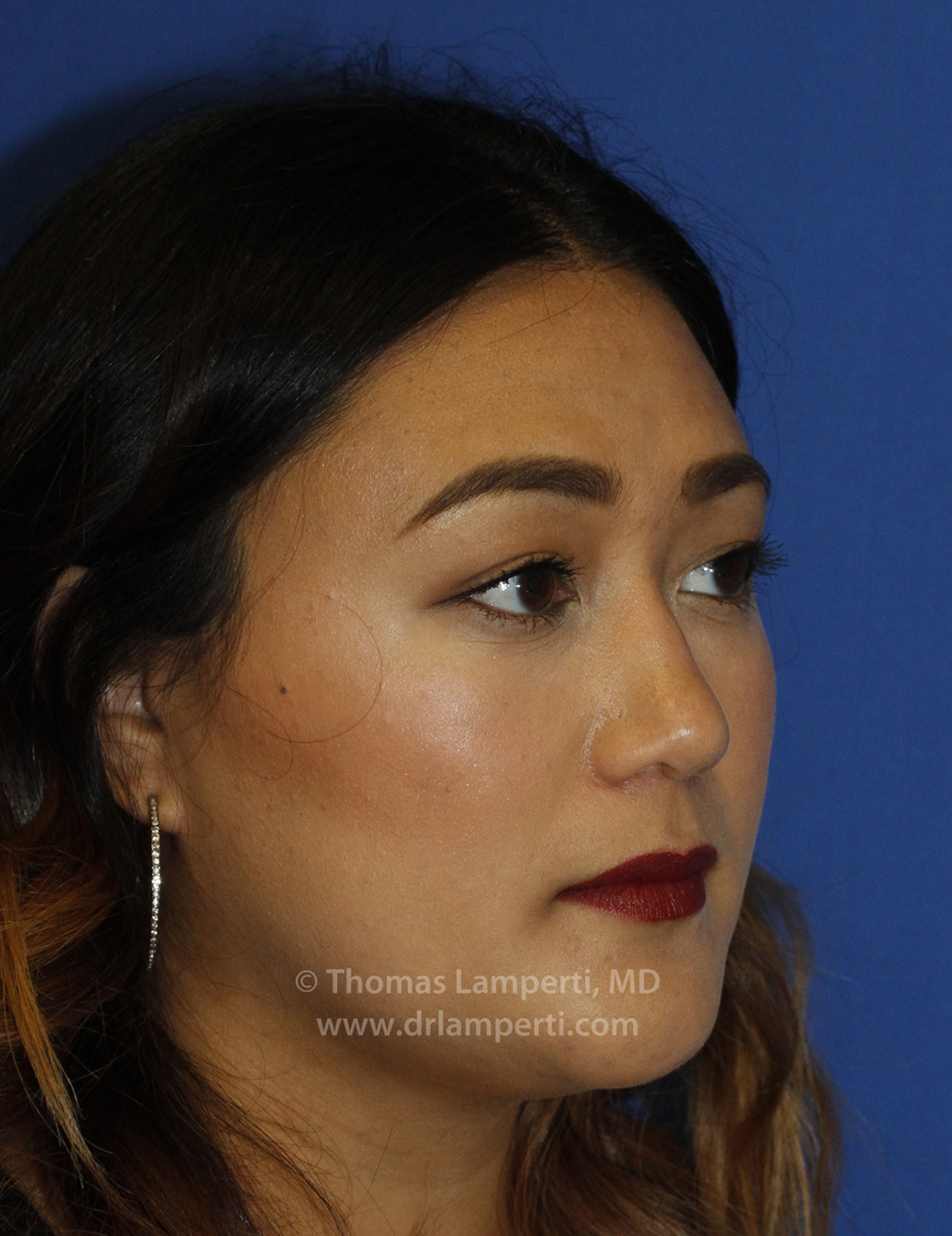 Rhinoplasty R Oblique After