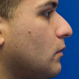 Before Rhinoplasty Profile Photo