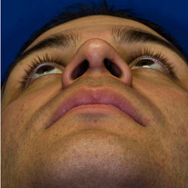 After Rhinoplasty Base Photo