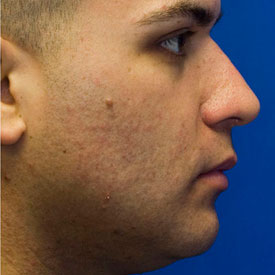 After Rhinoplasty Profile Photo