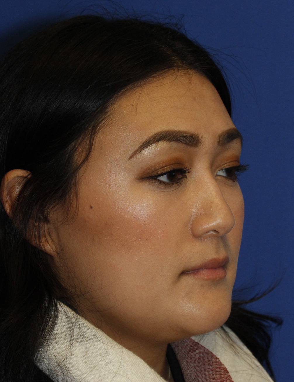 Rhinoplasty R Oblique Before