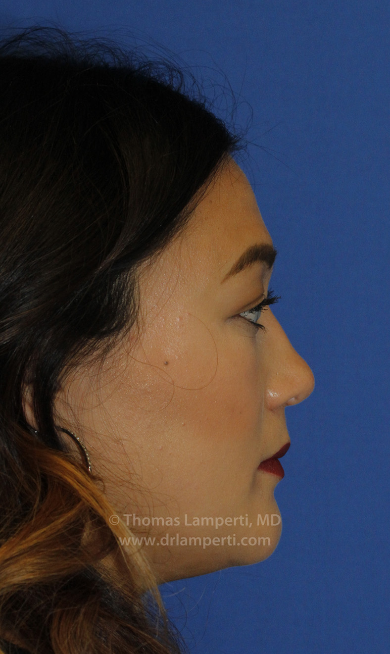 Rhinoplasty R Profile After