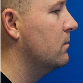 After Rhinoplasty Profile Photo