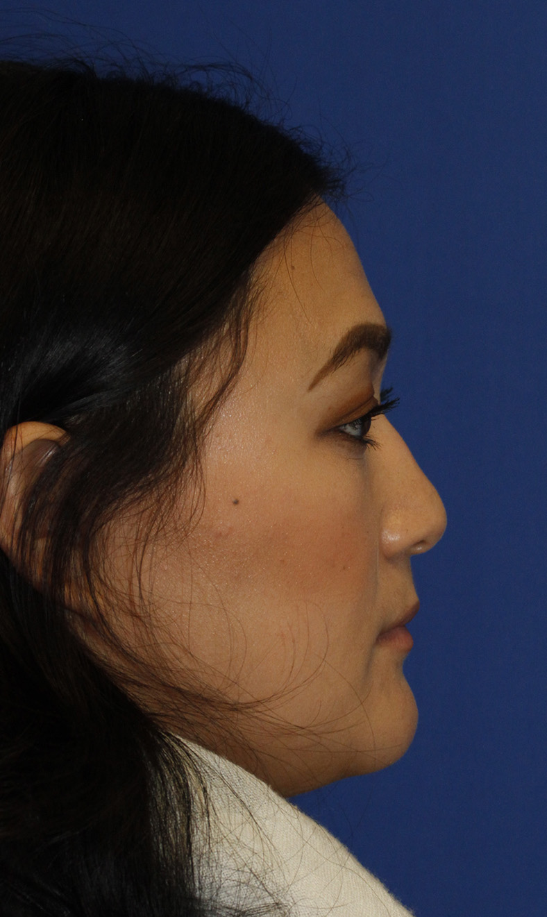 Rhinoplasty R Profile Before