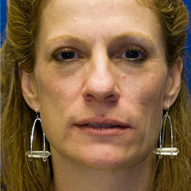 Before Rhinoplasty Frontal Photo