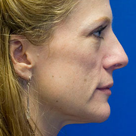 Before Rhinoplasty Profile Photo