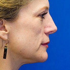 After Rhinoplasty Profile Photo