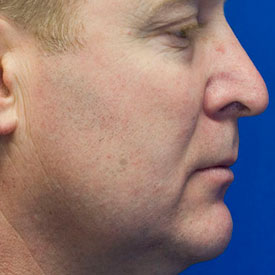 Before profile rhinoplasty photo